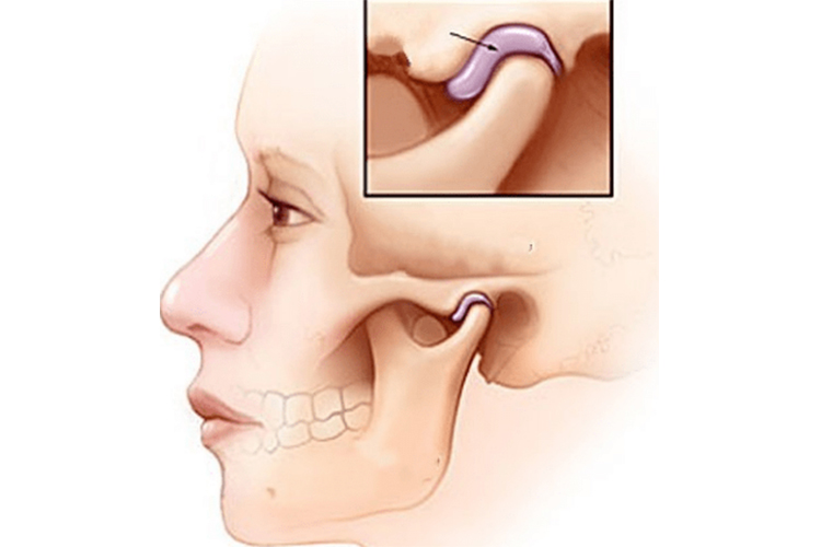 颞下颌关节位置图 颞下颌关节位置图
