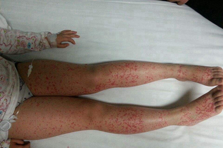 小儿过敏性紫癜腿症状图 小儿过敏性紫癜腿症状图