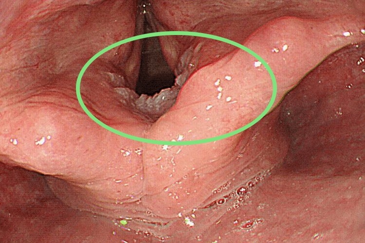 喉癌内窥镜下图