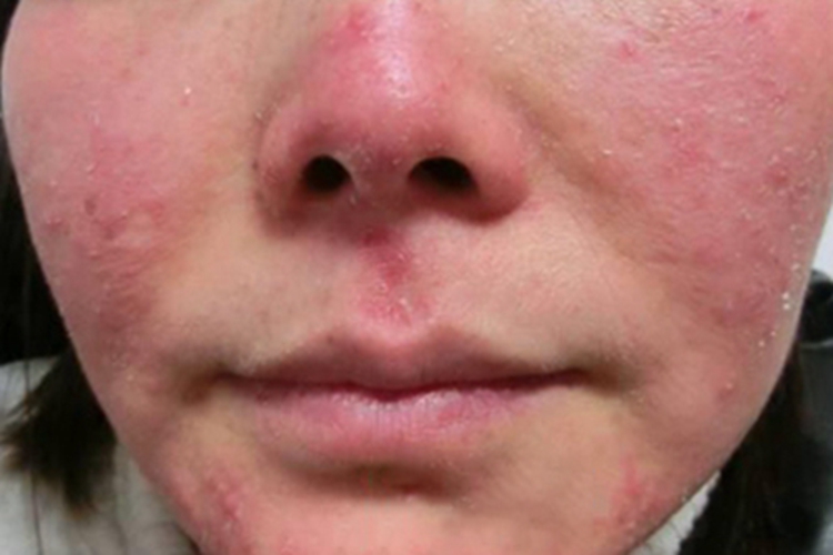 暴发性玫瑰痤疮面部脱屑图 暴发性玫瑰痤疮面部脱屑图