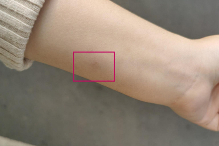 PPD皮试阴性有硬结图