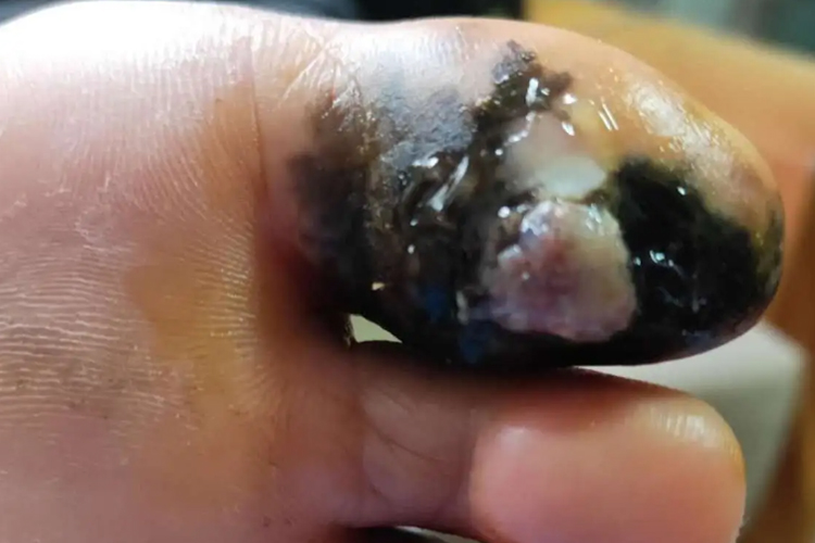 大脚趾头有黑色素瘤并溃烂图