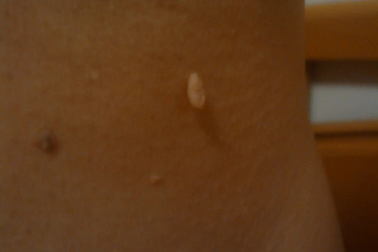 腋下尖锐湿疣图 腋下尖锐湿疣图