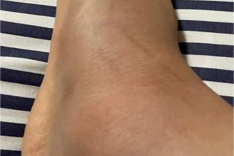 踝扭伤脚踝凸起大包图