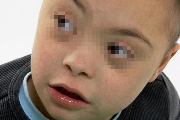 孩子唐氏综合征面相图