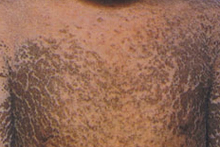 X连锁鱼鳞病胸部干燥裂痕图 X连锁鱼鳞病胸部干燥裂痕图