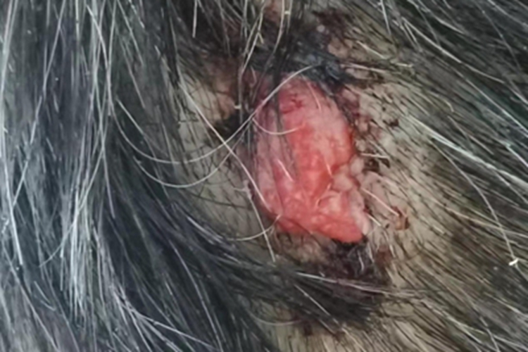 化脓性肉芽肿头皮肿块图 化脓性肉芽肿头皮肿块图