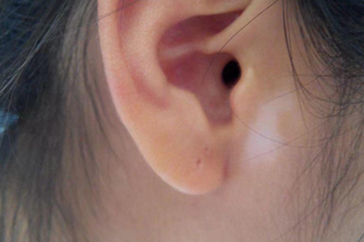 白癜风耳前白斑图