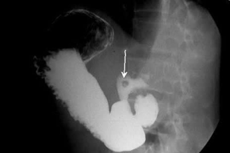 胃肠道肿瘤造影图 胃肠道肿瘤造影图