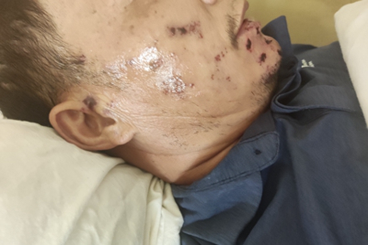 带状疱疹面部好多黑痂图