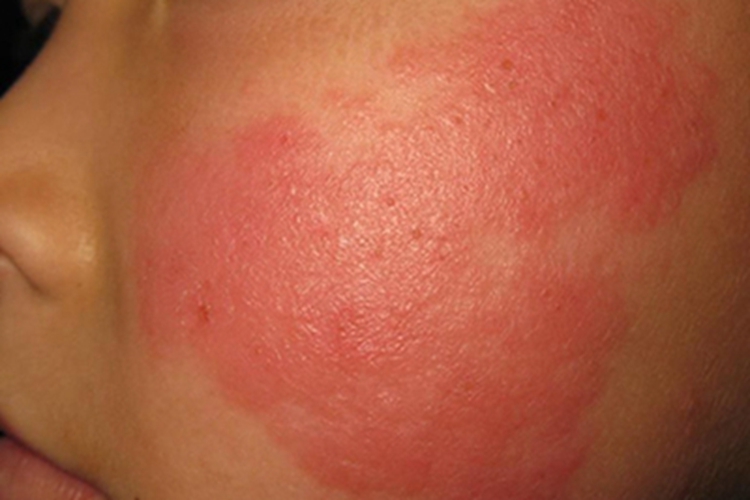 职业性光变应性接触性皮炎面部红斑图 职业性光变应性接触性皮炎面部红斑图