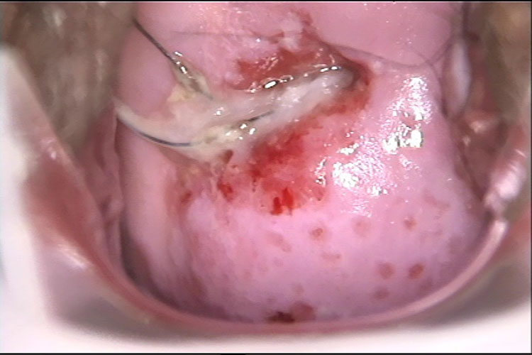 阴道炎分泌物图