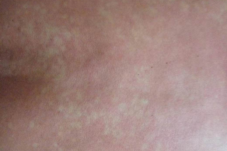 喝酒过敏皮肤泛红图