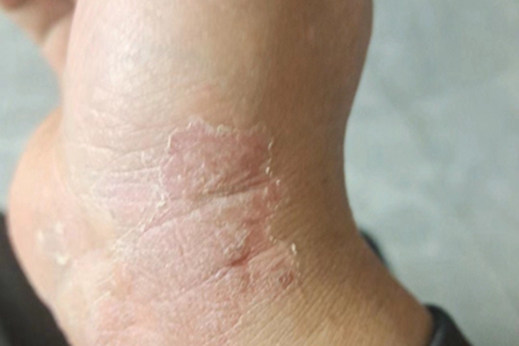 亚急性湿疹手腕脱皮图