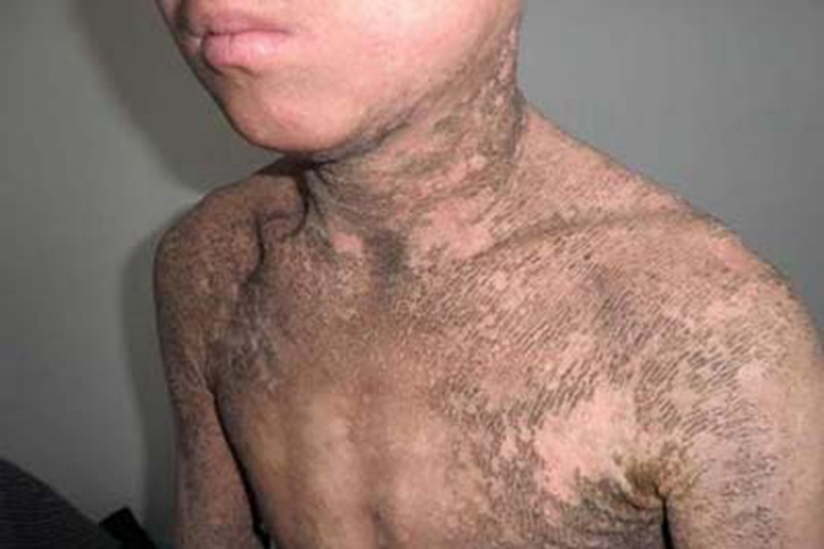 X连锁鱼鳞病全身脱屑图 X连锁鱼鳞病全身脱屑图