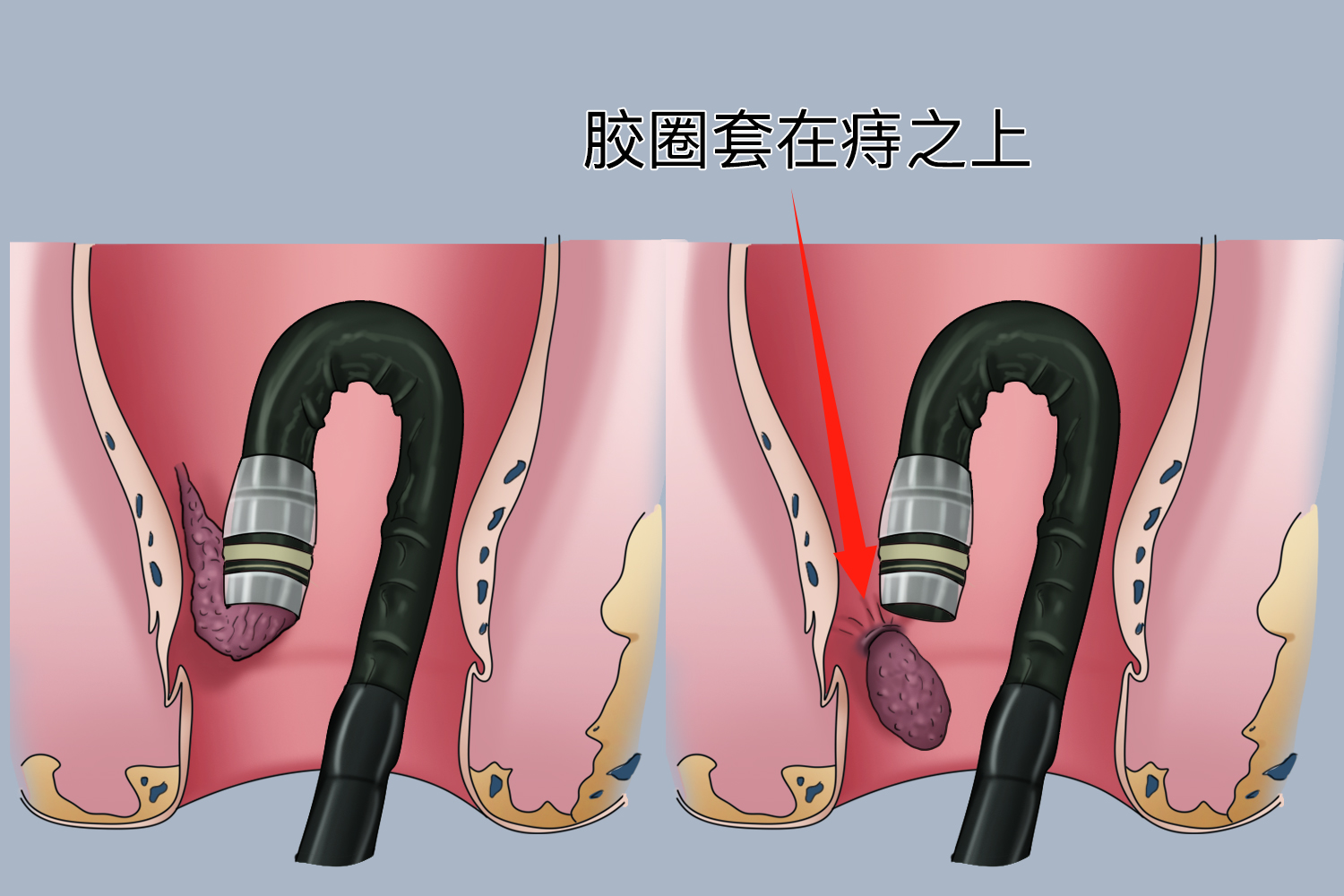 痔疮手术套扎图 痔疮手术套扎图