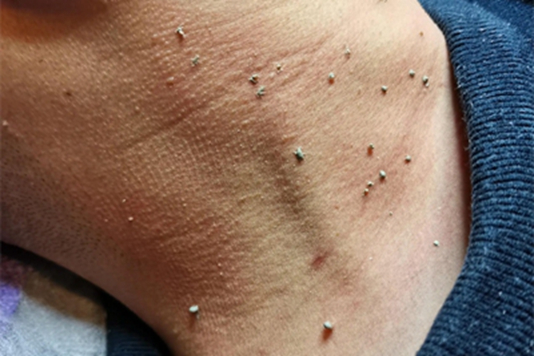 丝状疣初期图 丝状疣初期图