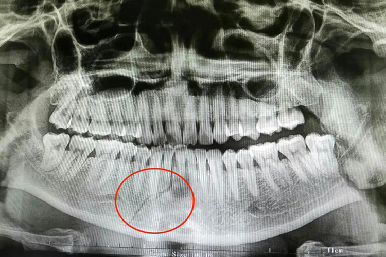 下颌骨骨折影像图