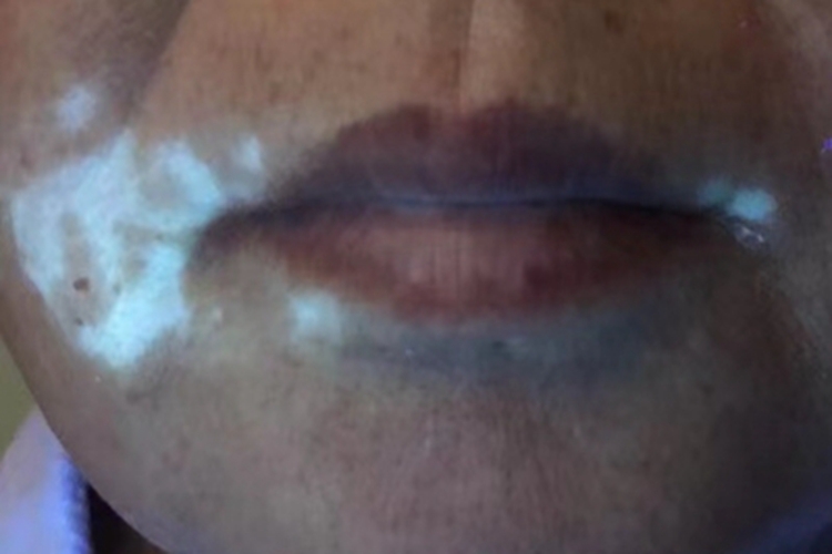 白癜风口周白斑图 白癜风口周白斑图