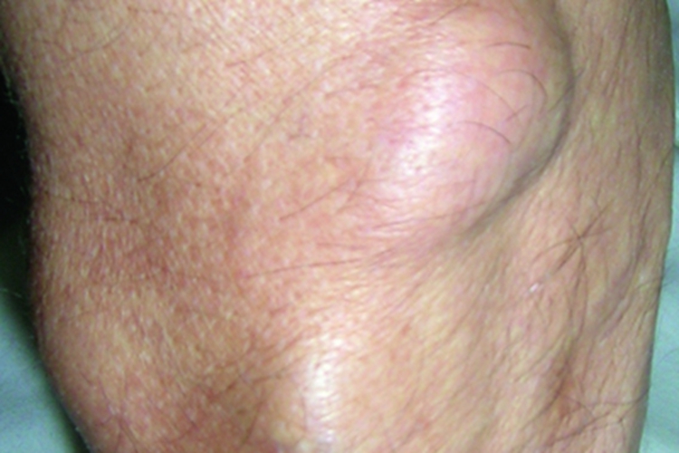 脂肪肉瘤大腿肿块图 脂肪肉瘤大腿肿块图