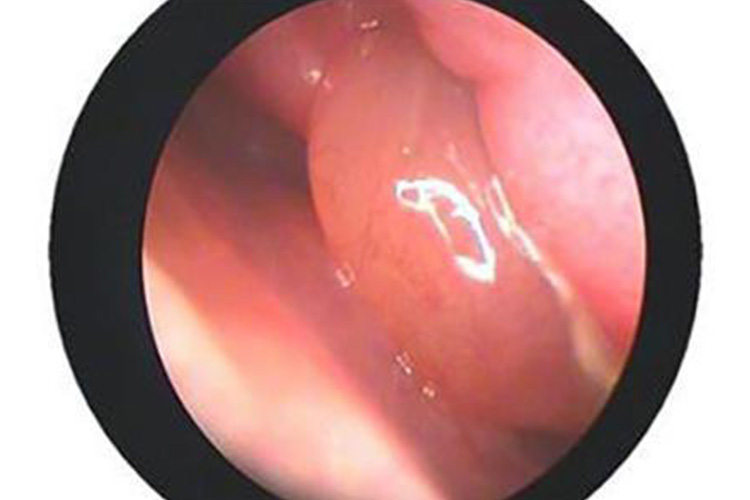 慢性鼻窦炎鼻甲反应性肿胀图