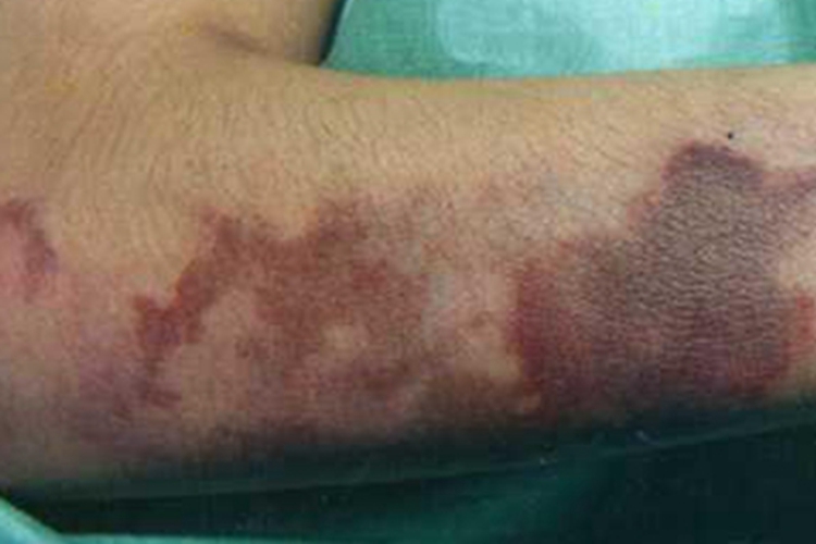 血小板减少性紫癜胳膊上有斑片图 血小板减少性紫癜胳膊上有斑片图