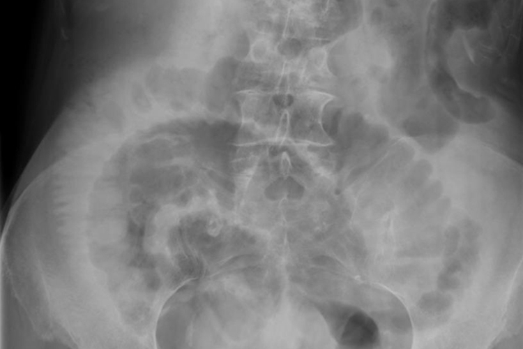 小肠梗阻X线图 小肠梗阻X线图