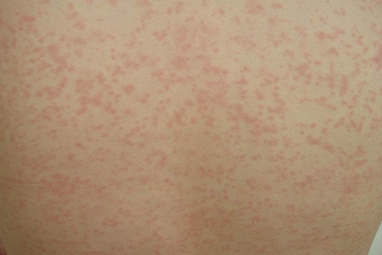 布洛芬过敏药物疹图 布洛芬过敏药物疹图