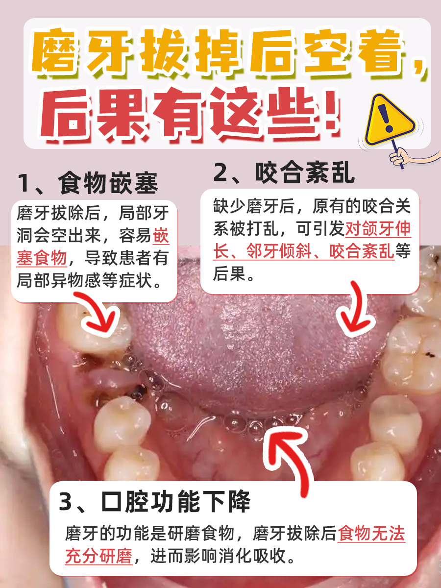 磨牙拔掉空着？后果你可能想不到！