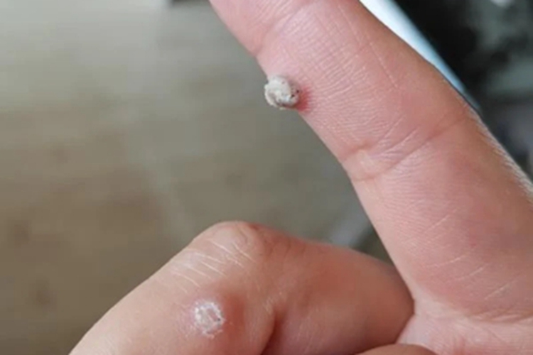 疣包块图 疣包块图