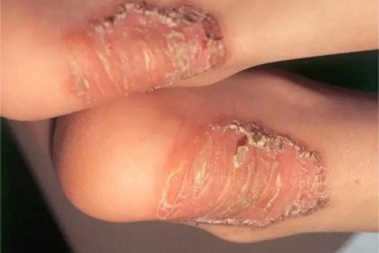 脓疱性肢端皮炎脚踝红斑图