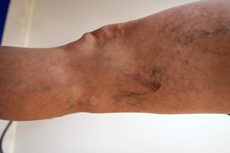 下肢静脉曲张大腿网状红血丝图 下肢静脉曲张大腿网状红血丝图