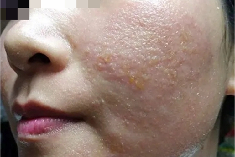 糖皮质激素依赖性皮炎红肿图