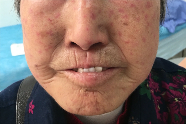系统性硬皮病嘴唇症状图