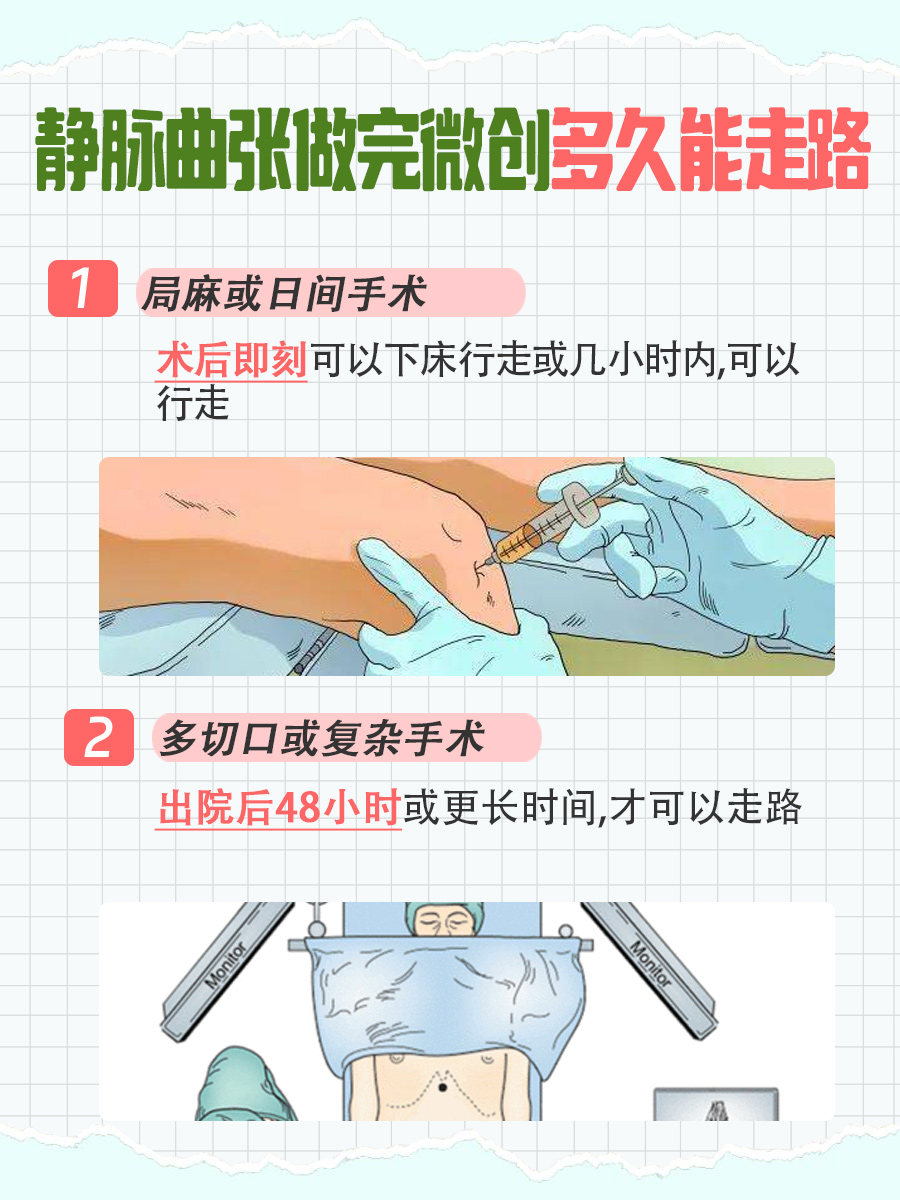 微创术后静脉曲张恢复：多久可恢复正常行走？