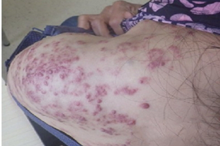 海绵状血管瘤肩部症状图