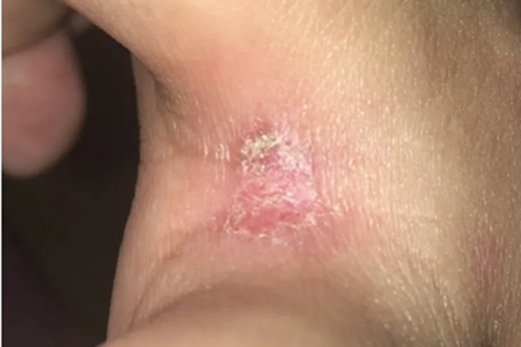 浸渍糜烂型手癣手指缝结痂图