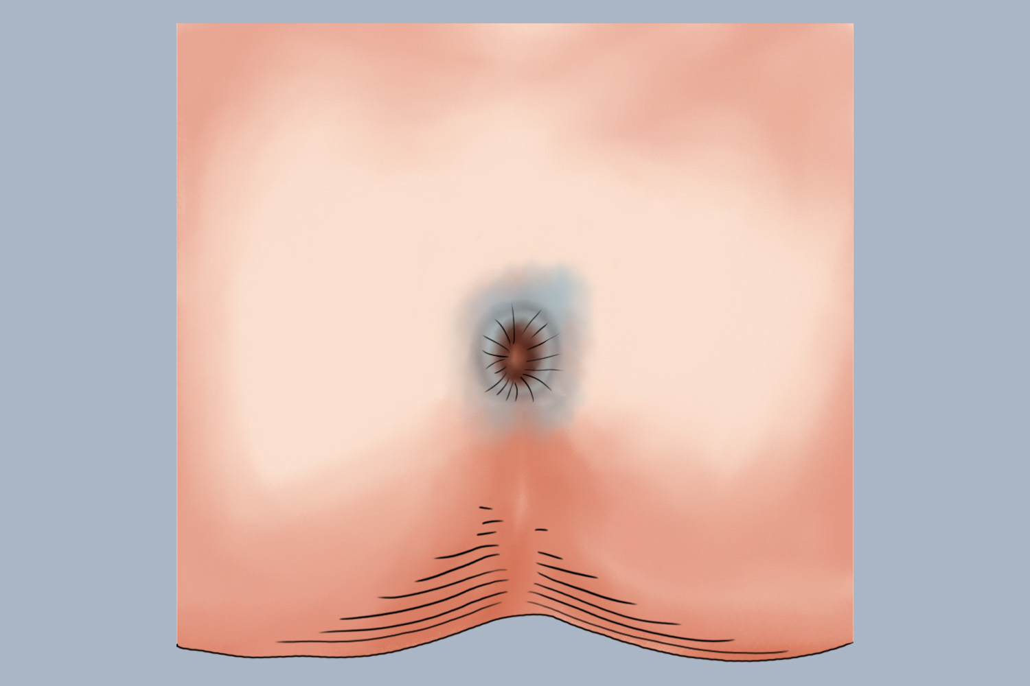 慢性湿疹肛门皮肤增厚图