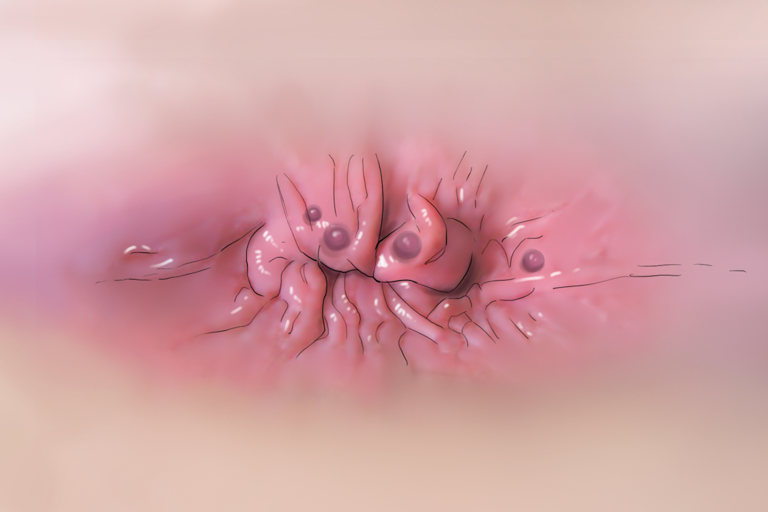 梅毒肛周手绘图