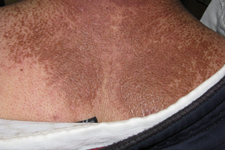 继发性皮肤淀粉样变背部丘疹图 继发性皮肤淀粉样变背部丘疹图