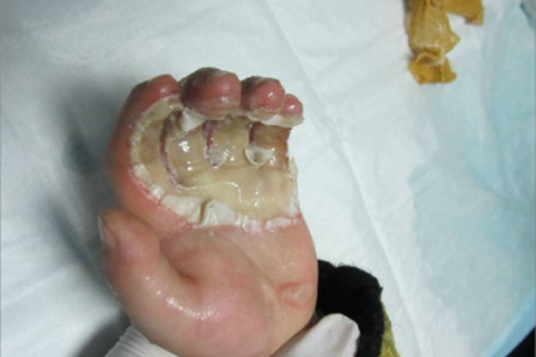 Ⅲ度烧伤手掌症状图