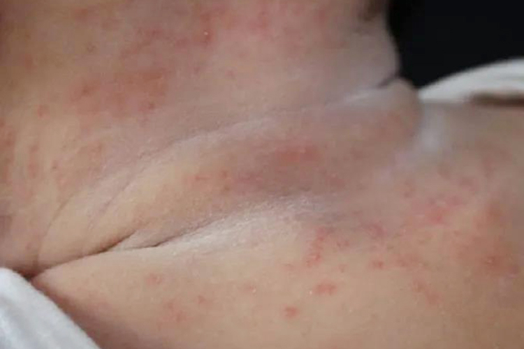 新生儿红痱图