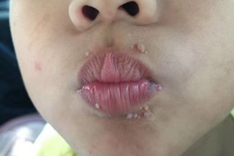 疣口周肉粒图 疣口周肉粒图