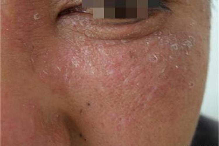 颜面再发性皮炎眼周脱屑图