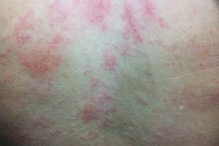 背部急性过敏图