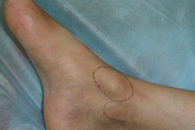 脚踝腱鞘炎局部隆起图