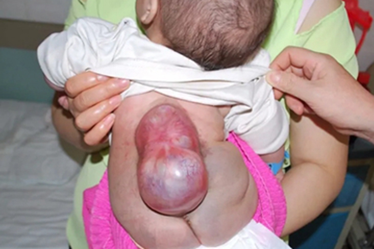 先天性脊柱裂大包图