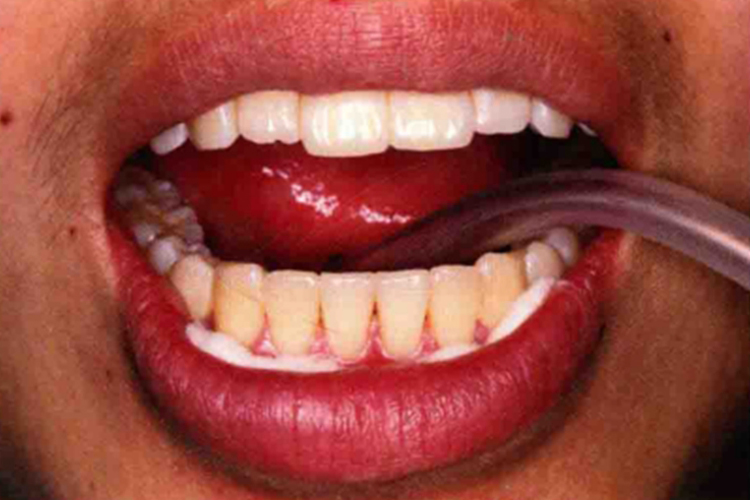 口腔吸唾管舌下放置位置图