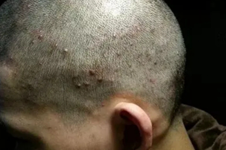 秃发性毛囊炎头皮脓疱图 秃发性毛囊炎头皮脓疱图