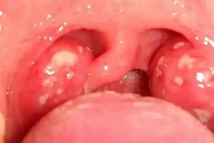 急性滤泡性扁桃体炎化脓图